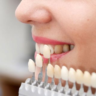 Dental Crowns