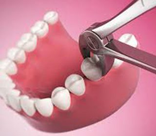 Dental Extractions