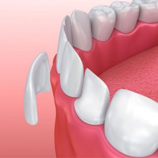 Dental Veneers
