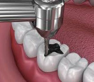 Dental Fillings